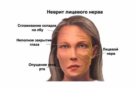 Диета лицевого неврита Причины, симптомы и лечение воспаления лицевого нерва (неврита) Причины, симптомы и лечение воспаления лицевого нерва (неврита) Диета лицевого неврита