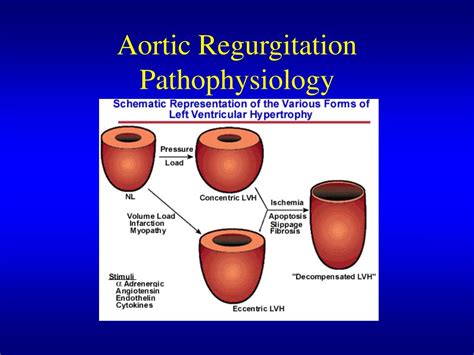 Aortic Regurgitation Pathophysiology