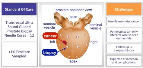 MDxHealth Improves Prostate Cancer Biopsies Nanalyze