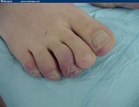 A 43 Year Old Woman With Painful And Discolored Toes