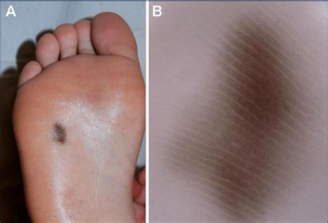 Clinical A And Dermoscopic B Aspect Of The Pigmented Macule