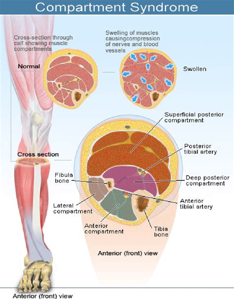 Compartment Syndrome The Orthopedic Sports Medicine Institute In