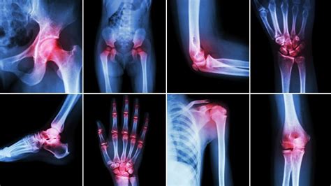 What Is Osteoarthritis Rheumatoid Arthritis And Gout And How Can They