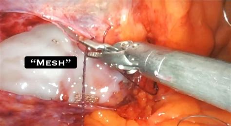 Driraniha Placed Mesh In Laparoscopy Inguinal Hernia Repair