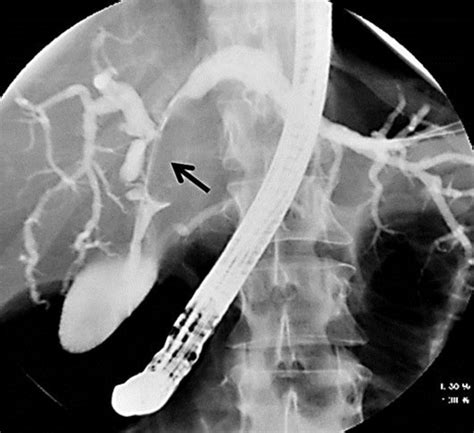 Appearance Of Biliary Cystadenoma During Ercp A Filling Defect