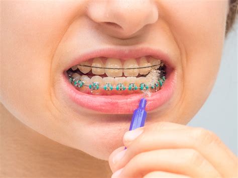 Steps On How Braces Work Beauty And Health Facts Online