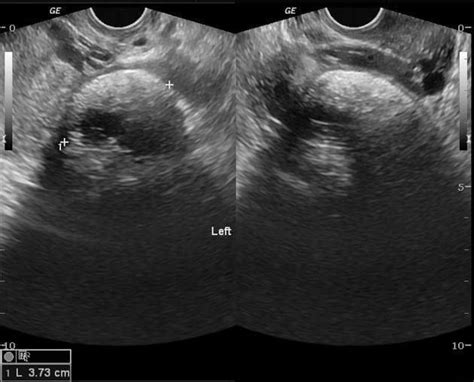 Ovarian Dermoid Ultrasound Is The Most Common Method Used For