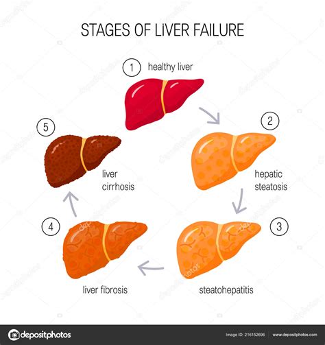 Stages Of Liver Damage Liver Disease Healthy Fatty Liver Fibrosis And