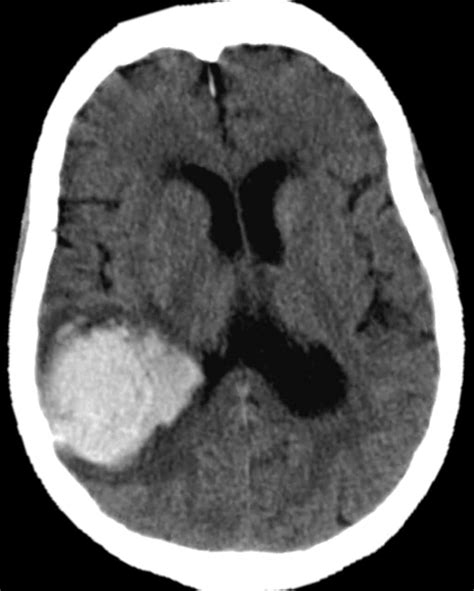 Guidelines For The Management Of Spontaneous Intracerebral Haemorrhage