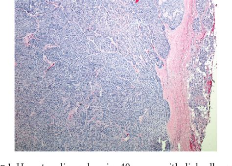 Figure 1 From Myoepithelioma Of The Parotid Gland A Case Report With