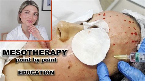 mesotherapy for face full demo and point by point injection technique youtube