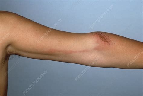 Inflamed Lymph Vessels In The Arm Stock Image C Science Photo Library