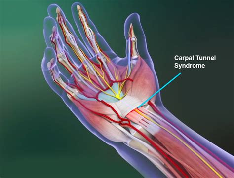 Carpal Tunnel Syndrome Queens Hand Surgery Brooklyn Carpal Tunnel
