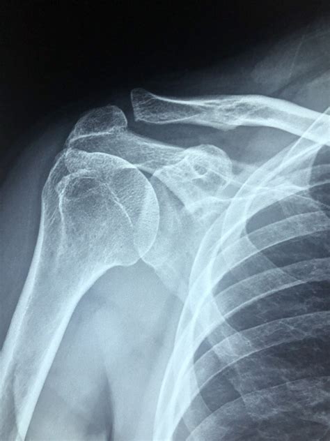 Shoulder Impingement 101 Dos And Donts Total Orthocare