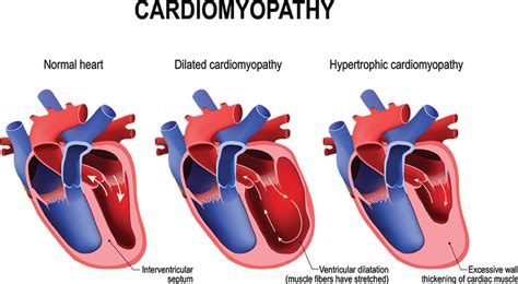 Alcoholic Cardiomyopathy Public Health