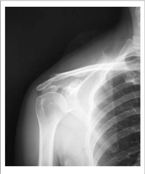 Figure 1 From Combined Arthroscopic Rotator Cuff Repair Leads To Better