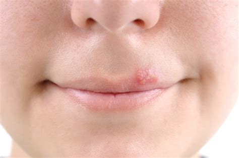 Are The Pimples On Your Lip Actually A Cold Sore Vivarivamobilya