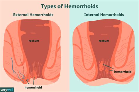 There are internal (inside the anus) and external. Hemorrhoids: Overview and More
