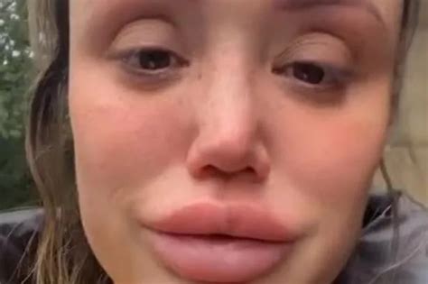 Charlotte Crosby Getting Lip Fillers Dissolved After Brutal Trolling