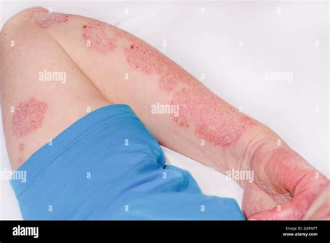 Acute Psoriasis On The Arm Of A Man Severe Redness On The Skin An