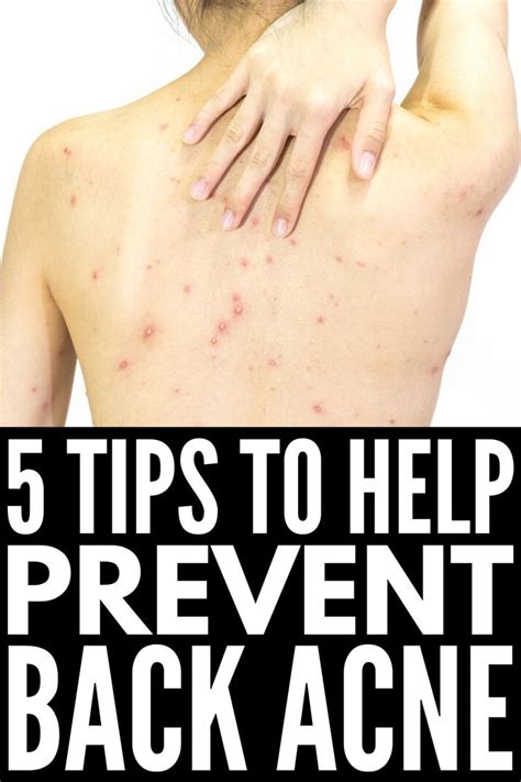 How To Get Rid Of Back Acne 11 Tips And Remedies That Work In 2020