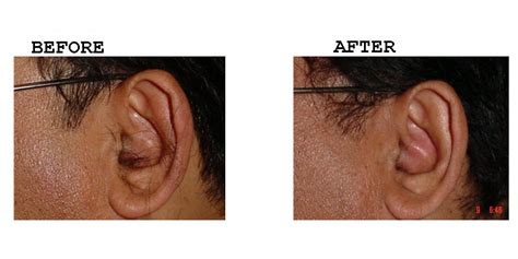 Ear Hair Removal Amrit Clinic
