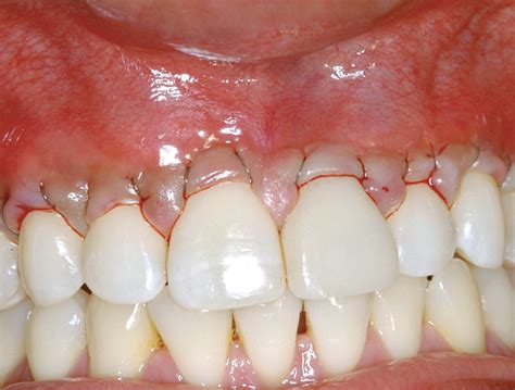 Gingival Grafting In The Esthetic Area Oral Health Group
