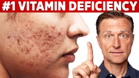 The Top Vitamin Deficiency With Acne Youtube