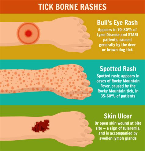 Pictures Of Rashes Caused By Tick Bites Picturemeta