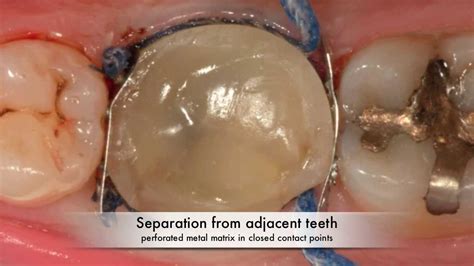 Restoration Of Severely Damaged First Lower Molar With Indirect Resin