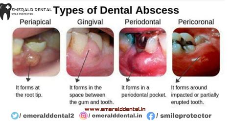 Types Of Dental Abscess Emerald Dental