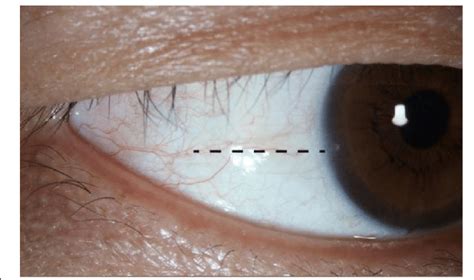 A Picture Demonstrates The Temporal Corneal Limbus The Black Dotted