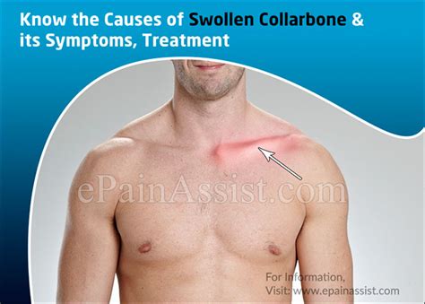 Know The Causes Of Swollen Collarbone And Its Symptoms Treatment