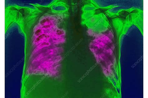 Pneumocystis Pneumonia Pcp X Ray Stock Image C0389058 Science