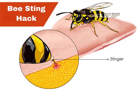 Home Treatment For Bee Sting Works Like Magic