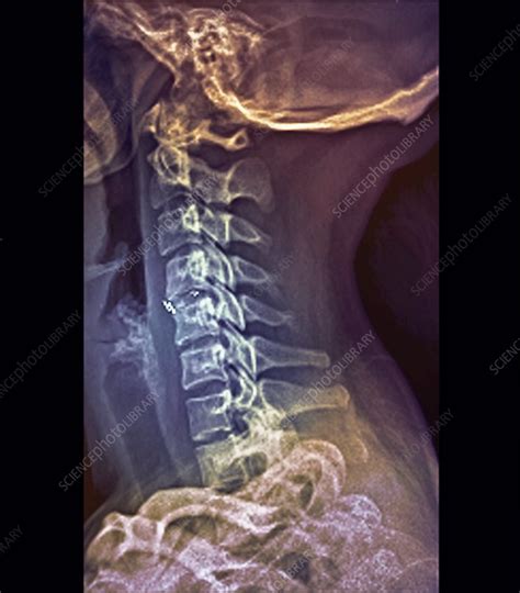 Intervertebral Bone Graft X Ray Stock Image M7000203 Science