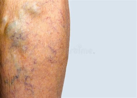 Varicose Veins On A Leg Stock Image Image Of Spider 88084995