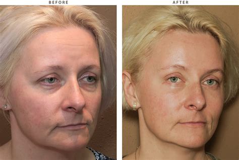 mid face lift before and after pictures dr turowski plastic surgery chicago