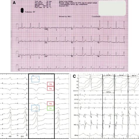Twelve Lead Electrocardiogram Transthoracic Echocardiography And