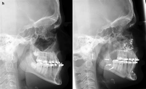 Cleft Jaw Deformities And Their Management Pocket Dentistry