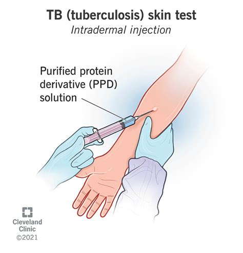 Tb Tuberculosis Test Purpose Procedure And Results Tb Tuberculosis