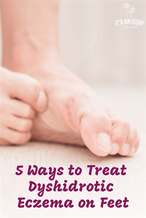 5 Ways To Treat Dyshidrotic Eczema On Feet Eczema How To Treat