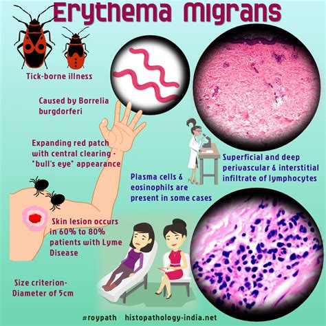 Pathology Of Erythema Migrans Pathology Teaching Biology Lyme Disease