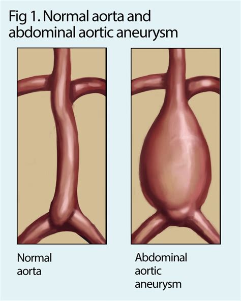 What Is An Aortic Aneurysm Abdominal Aorta Aortic Aneurysm Aneurysm