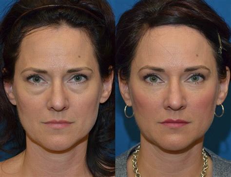 Eye Plastic Surgery Before And After Plastic Industry In The World