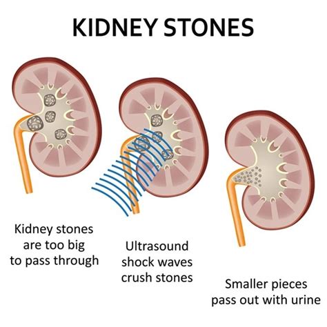 How Long Does Pain Last After Kidney Stone Surgery