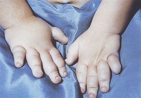 Turners Syndrome On Emaze 268