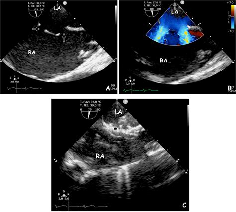 Trans Catheter Atrial Septal Defect Closure With The New Gore