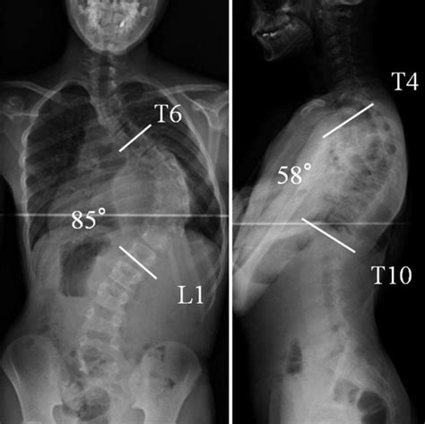 Standing X Ray Films Radiographs Indicated A Scoliosis Of 85° At T6 L1