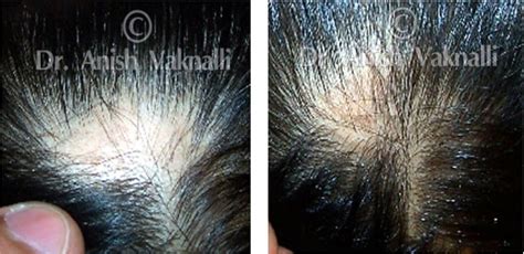 HomeoConsult RD Hair Loss Homeopathy Doctor Treatment Medicines